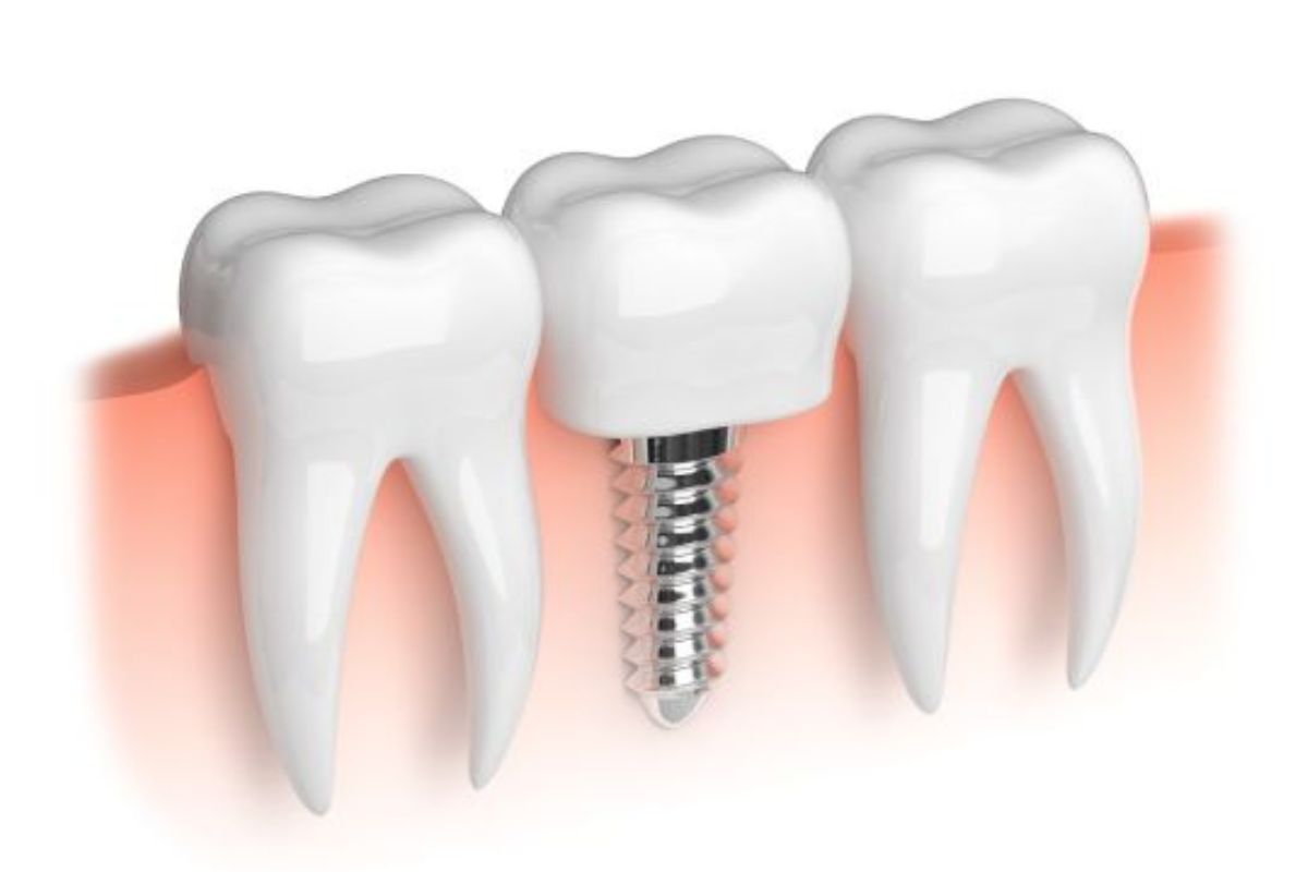 dental implants chandler