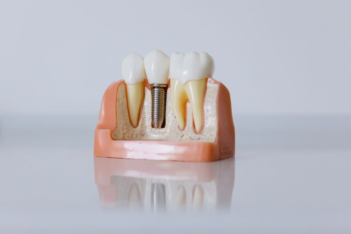 Dental Implants Chandler AZ